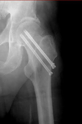 HIP REPLACEMENT SURGERY FROM CAR ACCIDENT – GOAL R2 000