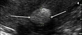 FIBROID EMBOLIZATION – R200 000