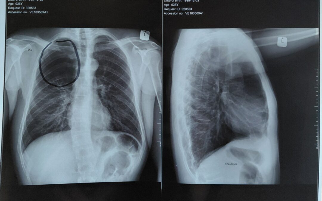 CT SCAN FOR LYMPHOMA – R20 000