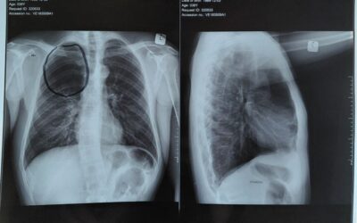 CT SCAN FOR LYMPHOMA – R20 000